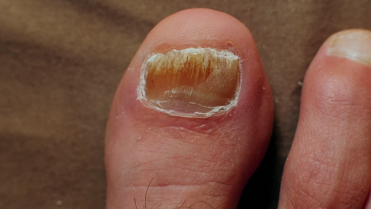 la aplicación de un potente medicamento antifúngico a la uña del dedo gordo