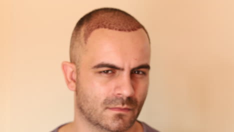 man with newly transplanted hair, scabs still covering it