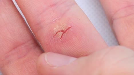 Wound-on-the-hand-caused-by-dry-skin,-macro-shot-close-up-detail-view