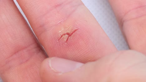 wound on the hand caused by dry skin, macro shot close up detail view