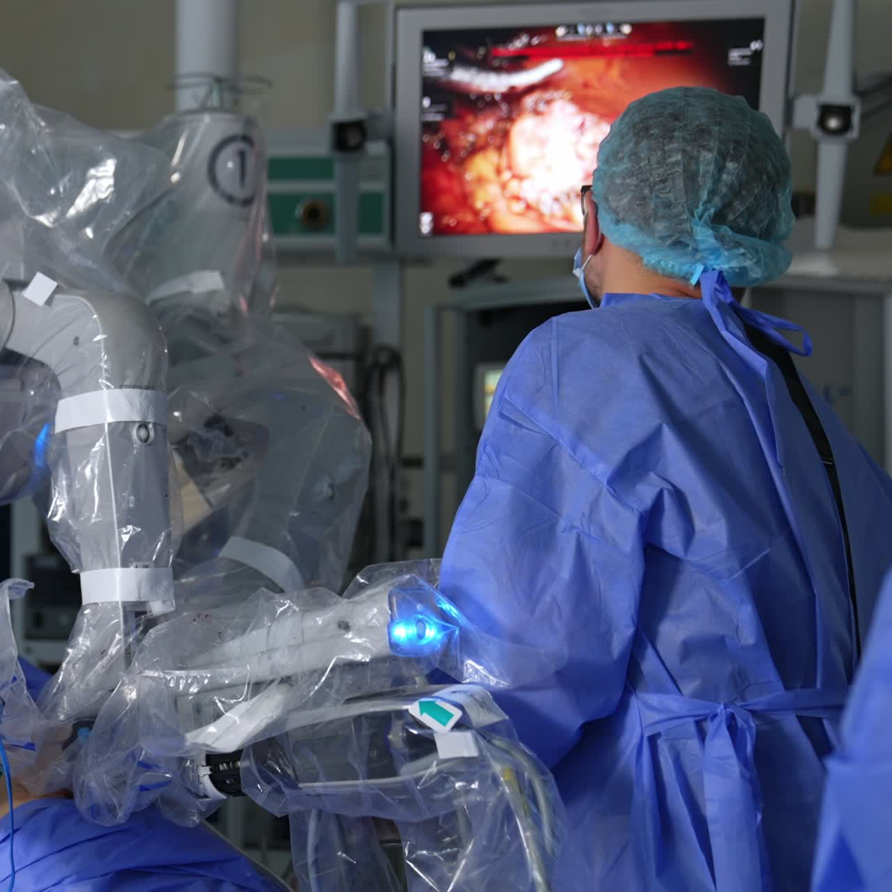 Slowly moving robotic arms input into patient's belly operating him. Male surgeon stands his back to camera looking at the screen with procedure process
