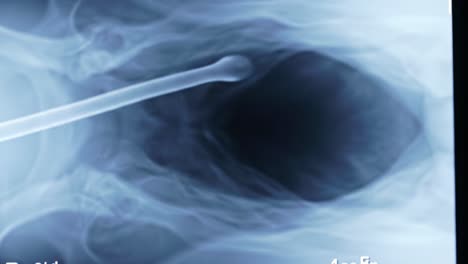 An x-ray displays the lung airway structure, prominently focusing on the trachea and bronchial passages. Observers can identify potential obstructions and assess airway conditions.