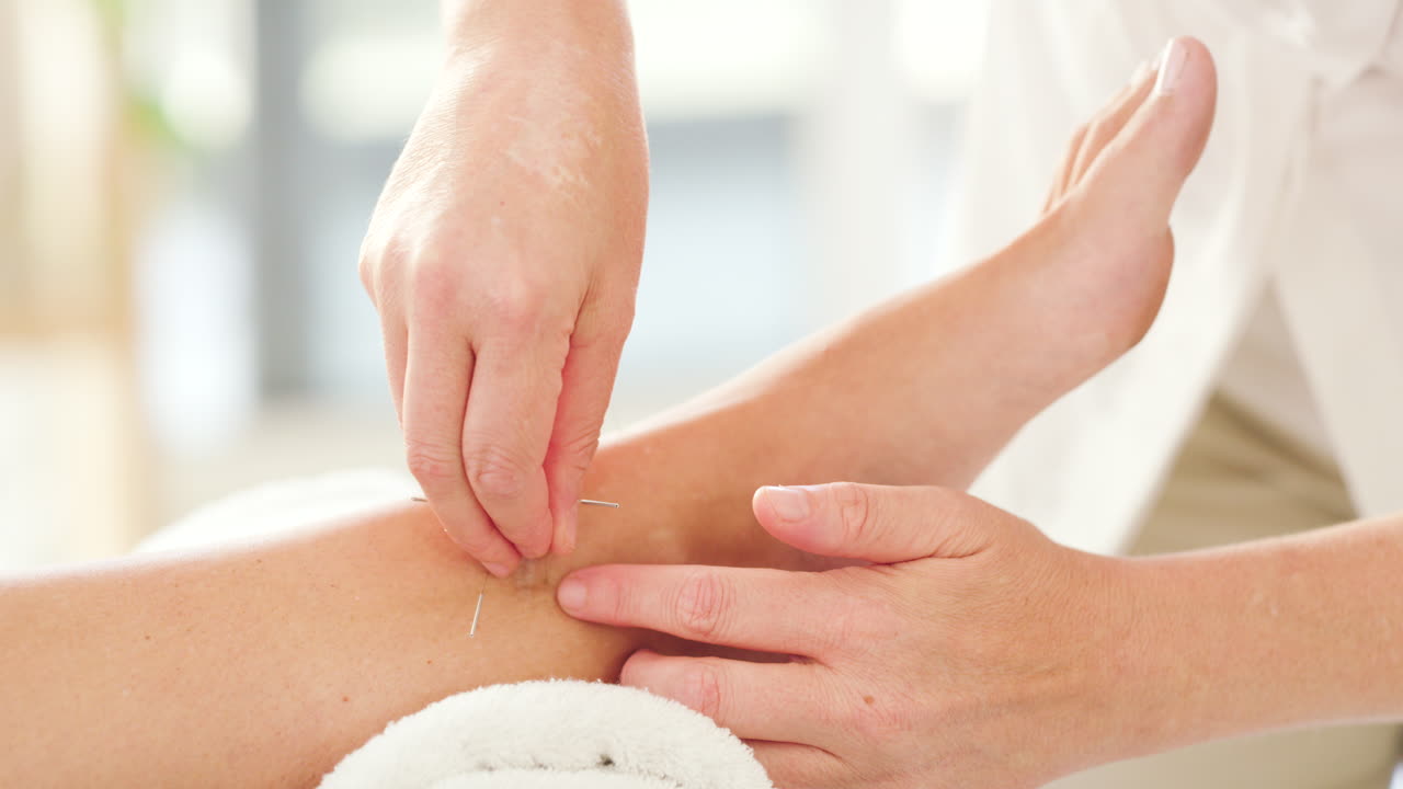 terapeuta insertando agujas de acupuntura en los clientes