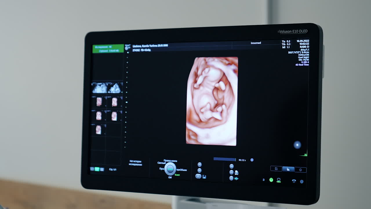 Black monitor with unborn baby image on. Ultrasound equipment for diagnostics of pregnancy.