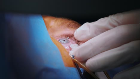 laser vision correction. a patient and team of surgeons in the operating room during ophthalmic surgery. eyelid speculum. lasik treatment. patient under sterile cover