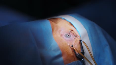 laser vision correction. a patient and team of surgeons in the operating room during ophthalmic surgery. eyelid speculum. lasik treatment. patient under sterile cover