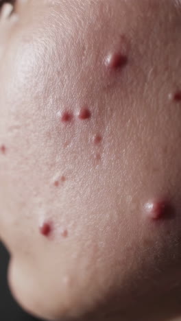 acne on face