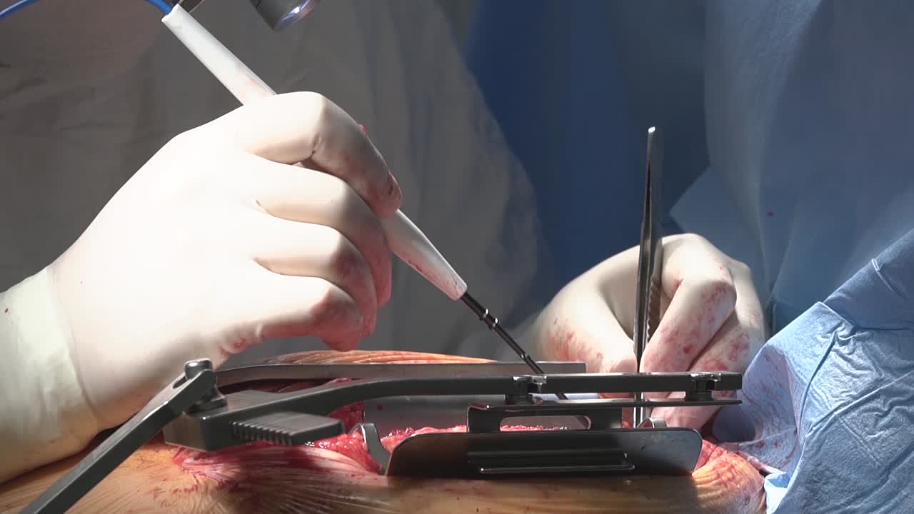 심장 수술 수술사는 응고기 도움으로 작업합니다.