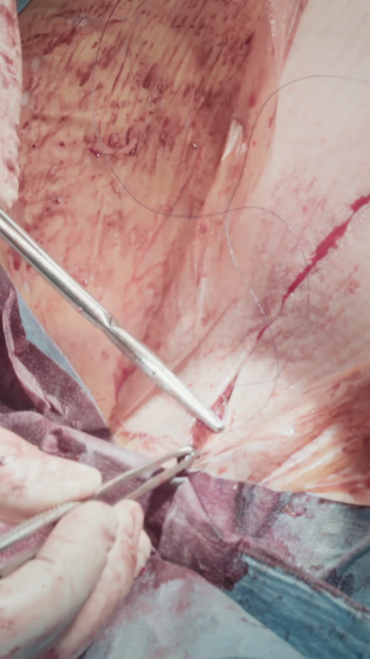 las manos del médico hacen suturas después de la cirugía. el cirujano cuidadoso cierra la incisión del pecho después de una exitosa cirugía de bypass de la arteria coronaria en el hospital.