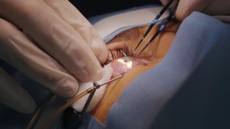 laser vision correction. a patient and team of surgeons in the operating room during ophthalmic surgery. eyelid speculum. lasik treatment. patient under sterile cover