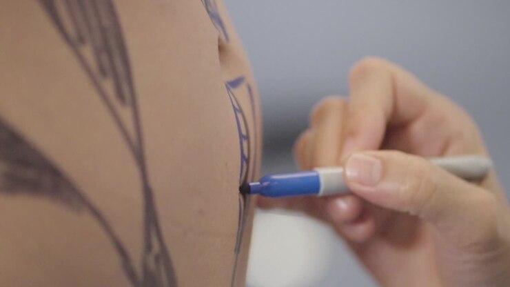 Plastic surgeon delicately marking areas with a pen for aesthetic interventions, demonstrating meticulous planning for precise cosmetic procedures