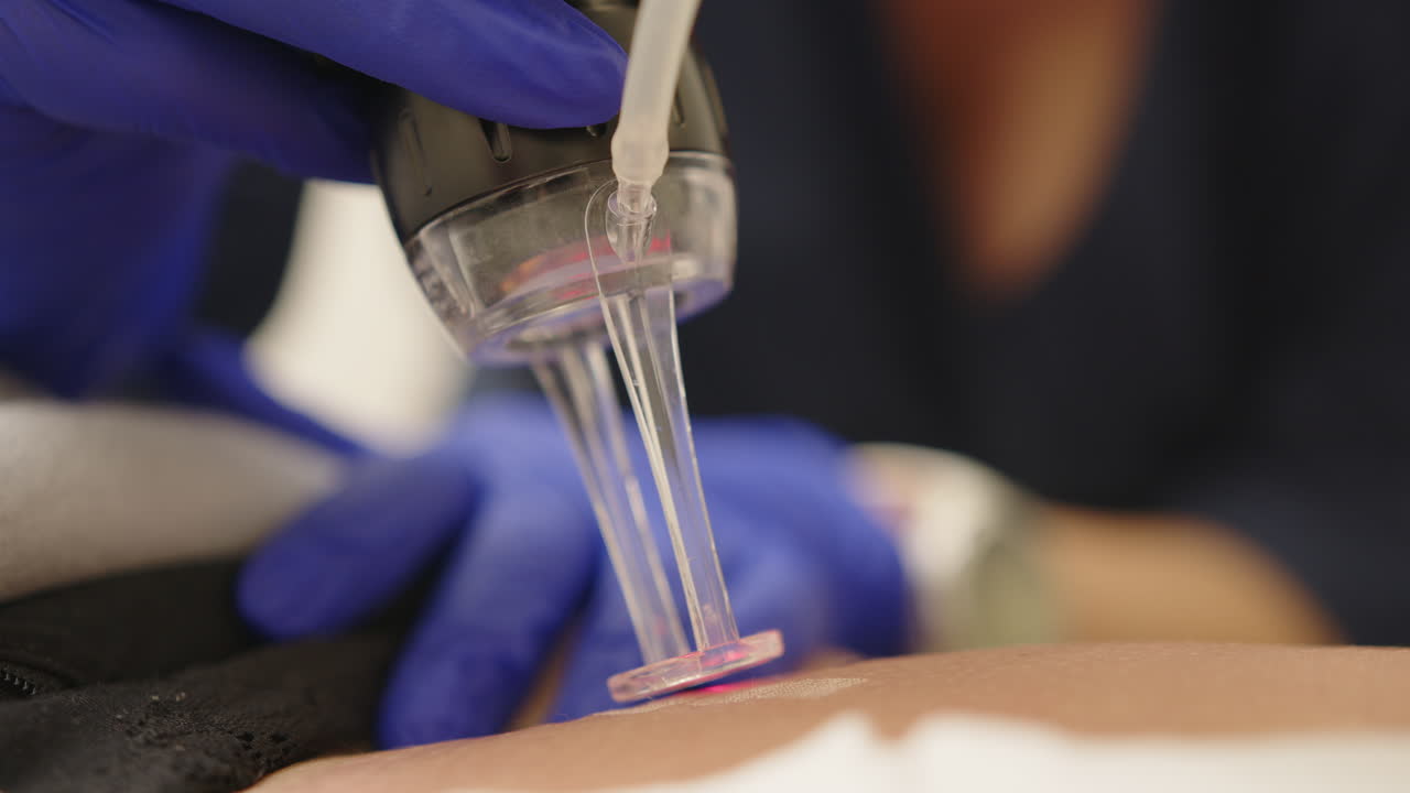 procedimiento de tratamiento cutáneo con láser