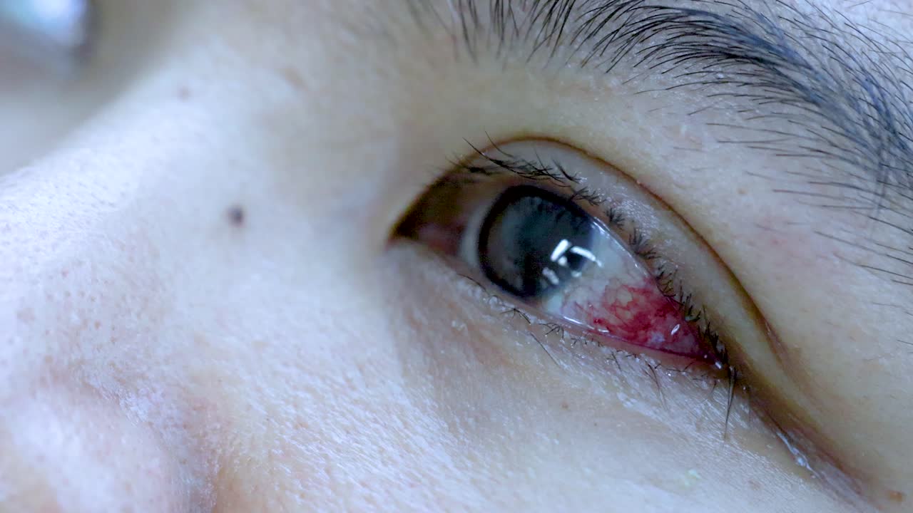 Macro video of inflamed, teary eye with conjunctival redness under soft, natural lighting