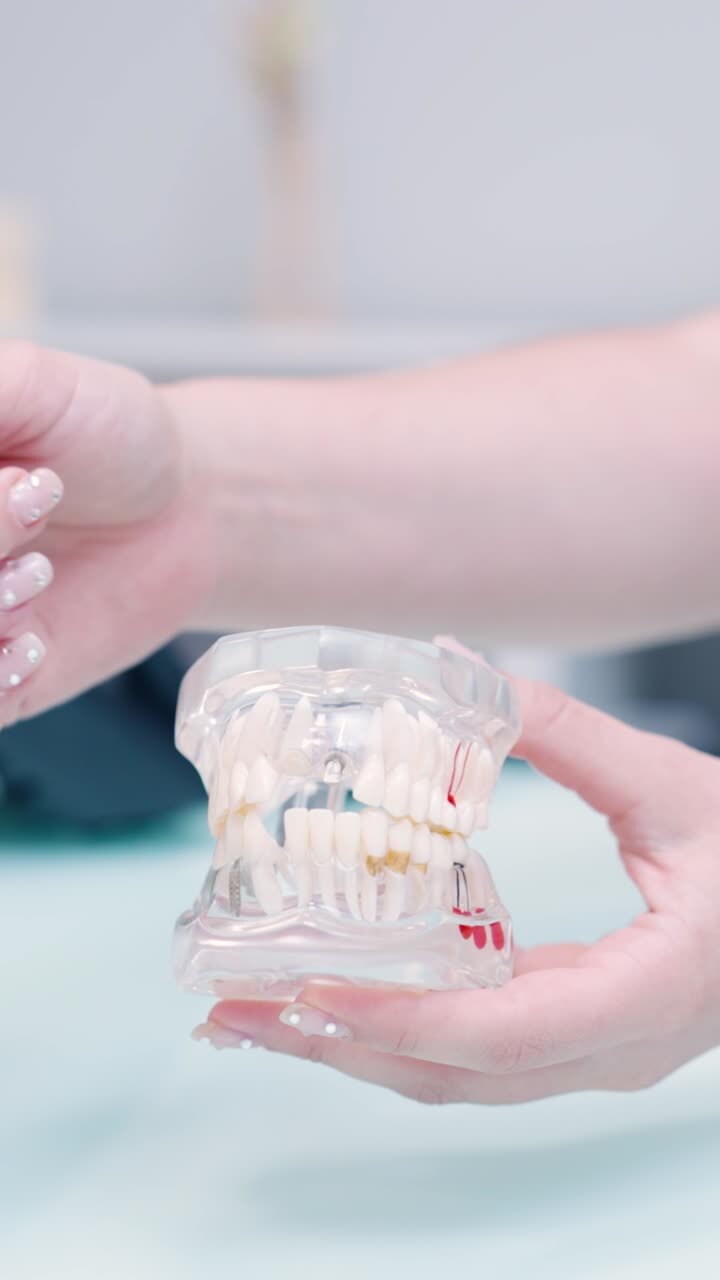 Dental Model with Implants