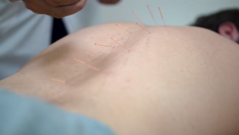 acupuncture treatment session