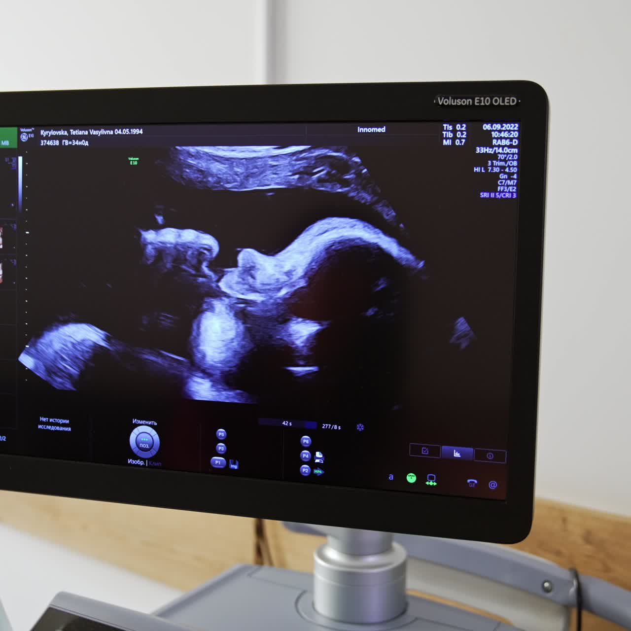Lindo rosto lateral de um bebê ainda não nascido chupando o polegar. Imagem de uma criança em exame de ultrassom em uma maternidade