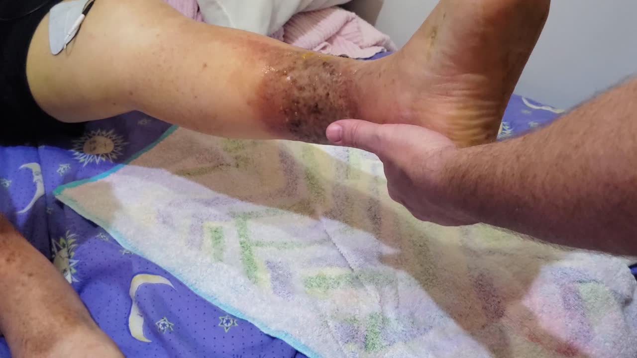 Fisioterapista che applica l'elettroterapia e il movimento assistito alla gamba di un paziente durante il trattamento di riabilitazione dopo una frattura del femore
