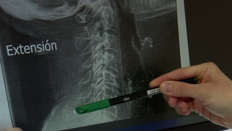 x-ray of cervical spine with extension