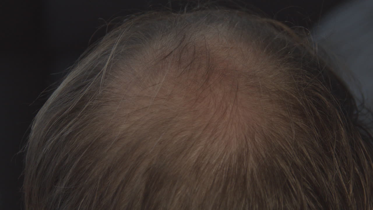 남자의 머리에 대머리를 통해 손을 가까이