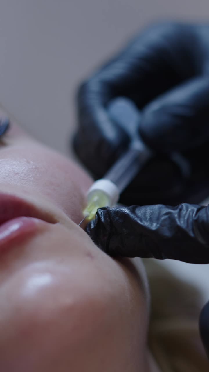 Mole removal procedure on a woman's face