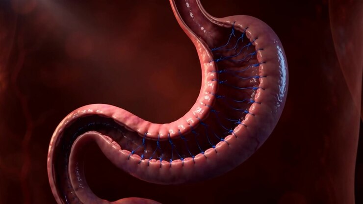 Cross section stomach narrowed by blue suture threads spanning its interior in medical animation view