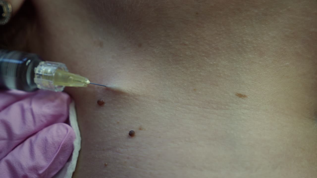 Mole Removal Procedure
