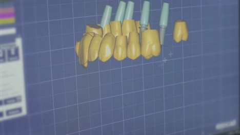 software de cad dental para el diseño de coronas de zirconia