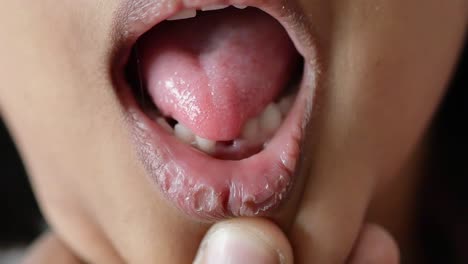 close-up of a child's mouth and lips with visible dryness and cracking