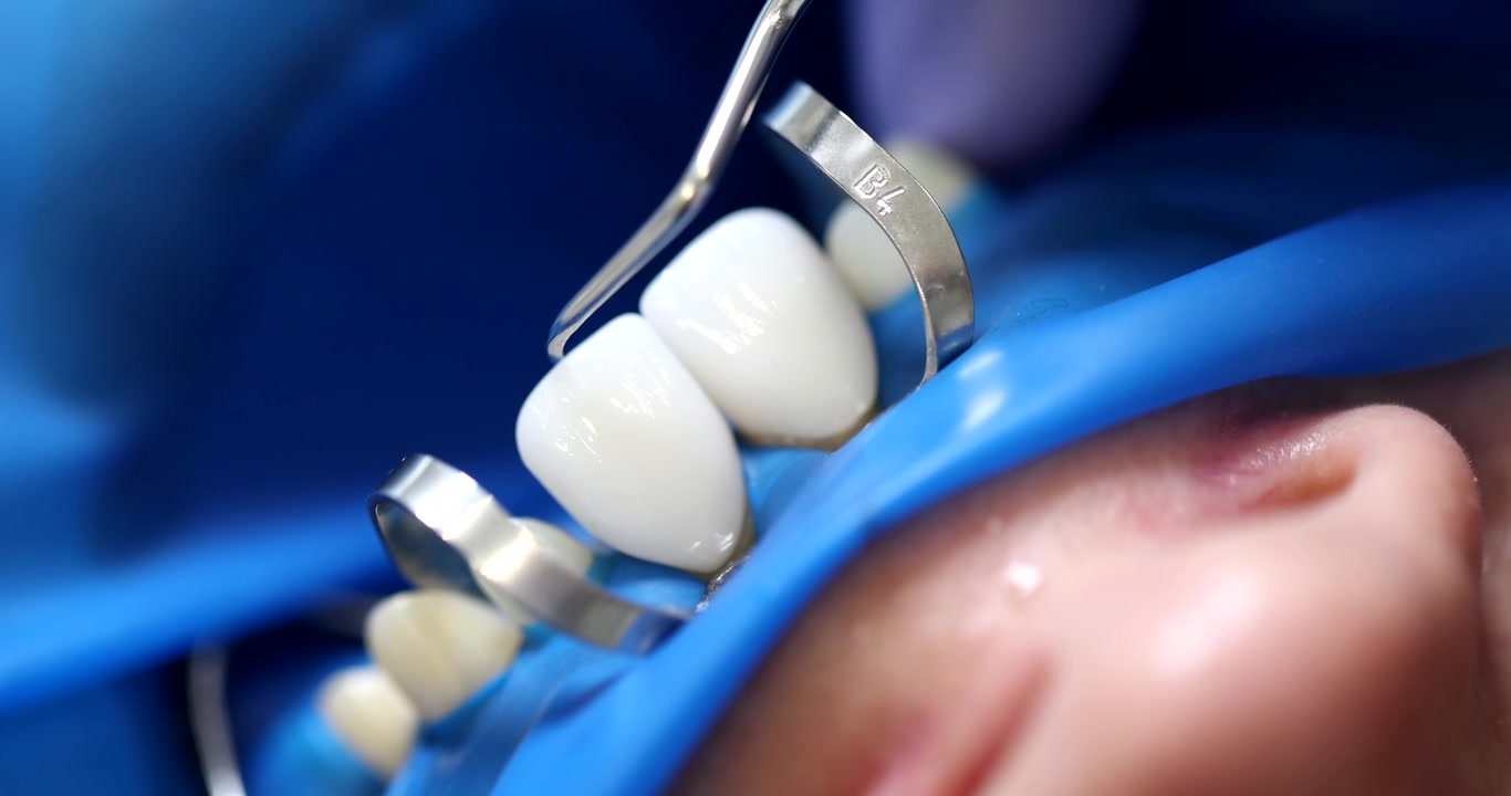 Dentist adjusts crown with precision and care during surgery