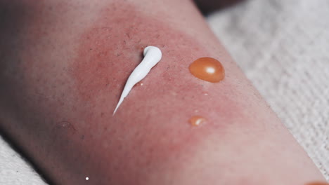 closeup of medical ointment being applied to swollen blisters with fluid infection and rash