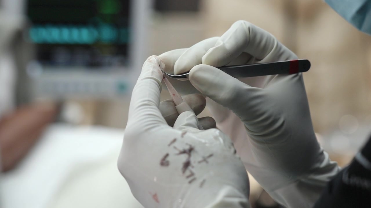 Trapianto di capelli FUE in clinica. Primo piano delle mani di un'infermiera che inserisce il follicolo nell'implanter Choi con un monitor della frequenza cardiaca sullo sfondo