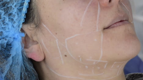 doctor trace marks with white pen on patients face