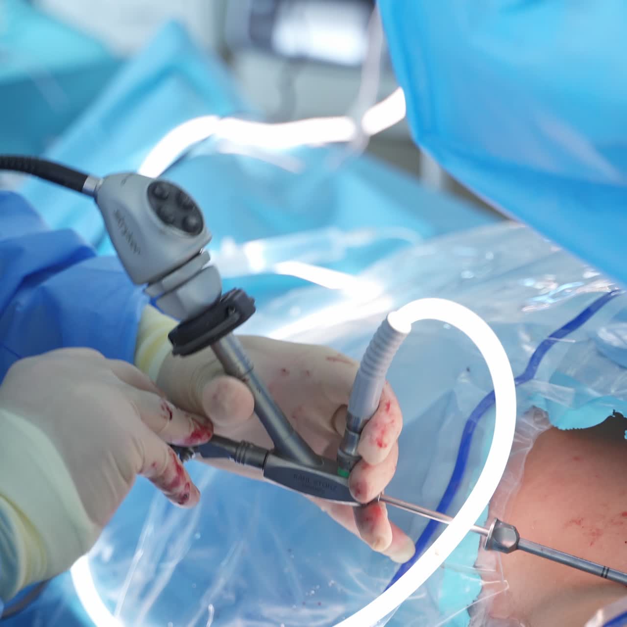 Team Performing Surgical Operation. Surgical team performing operation sterilized conditions in hospital operating room