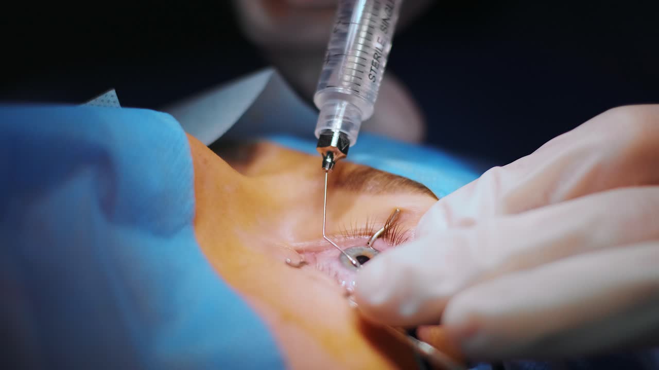 레이저 시력 교정: 안과 수술 중에 수술실에 있는 환자와 수술팀; 눈꺼풀 스럼; 라식 치료; 불임 개 아래의 환자