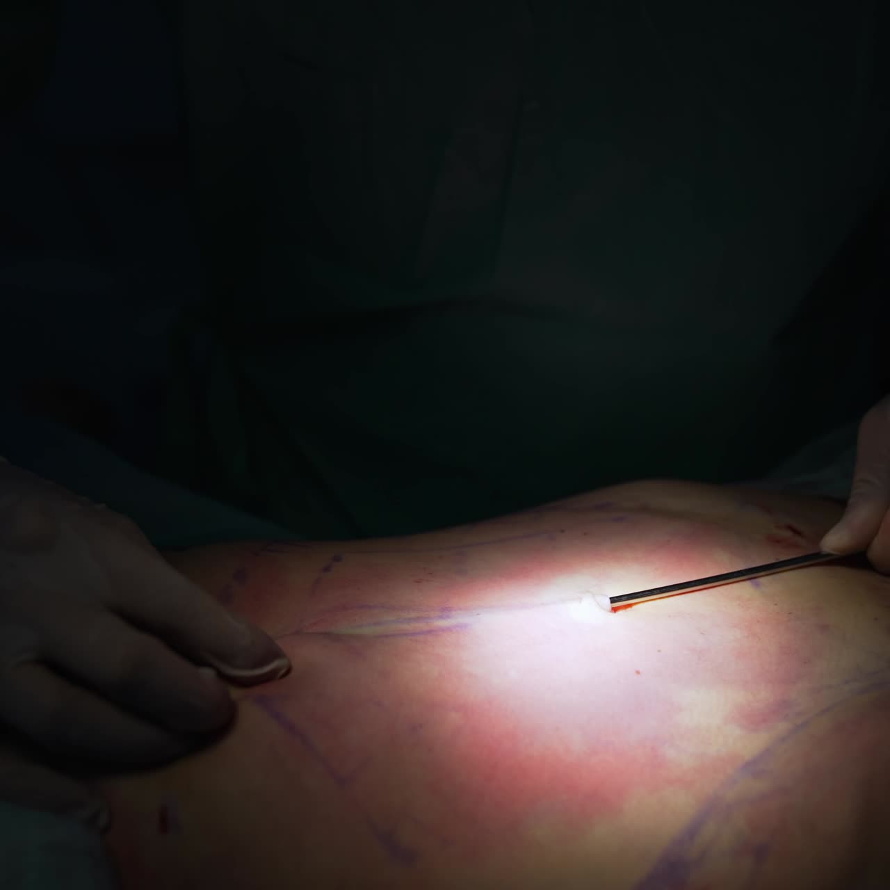 Surgeon makes a liposuction operation at the belly of a patient. Abdominal liposuction in hospital operating room. Doctor's precise work with liposuction instruments close up