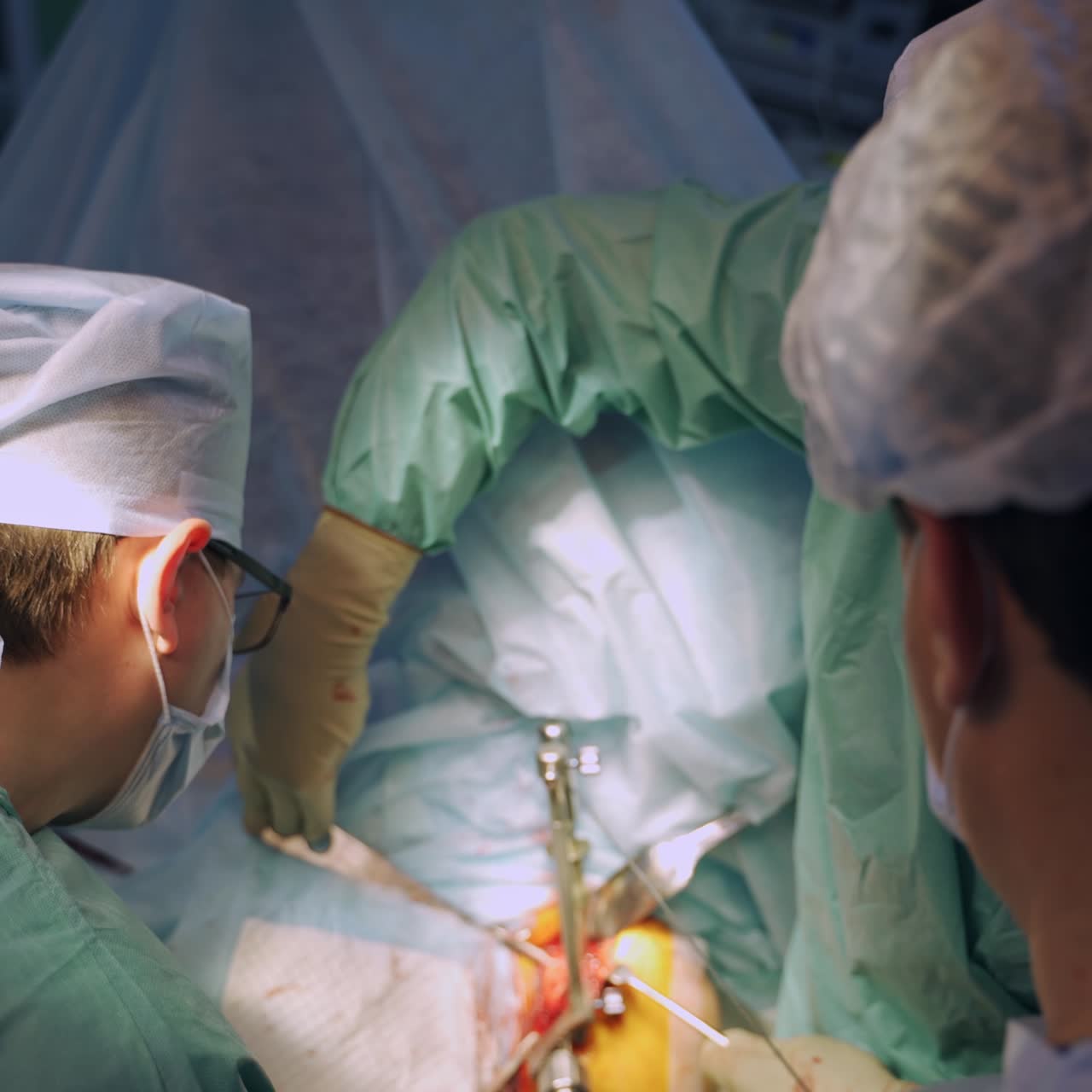 Surgeons settled special metal supports on the body of a patient. Surgical operation conducted by the experienced medics. High angle view