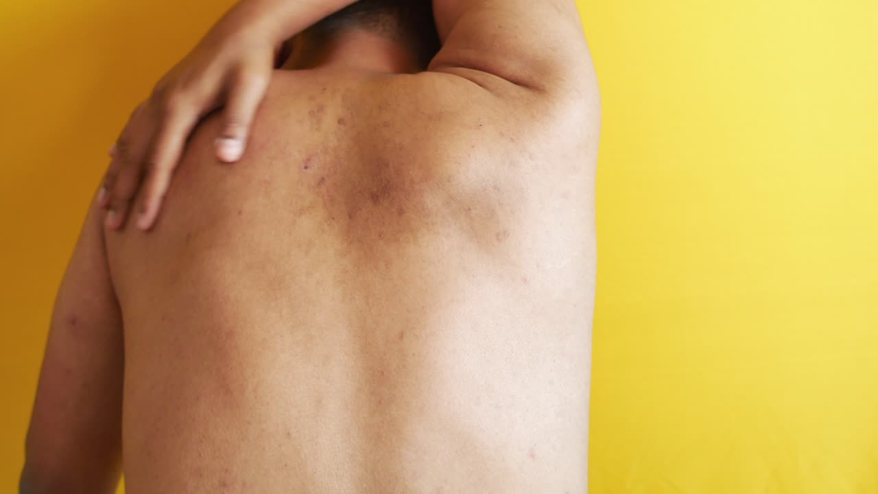 persona con enfermedad de la piel en la espalda