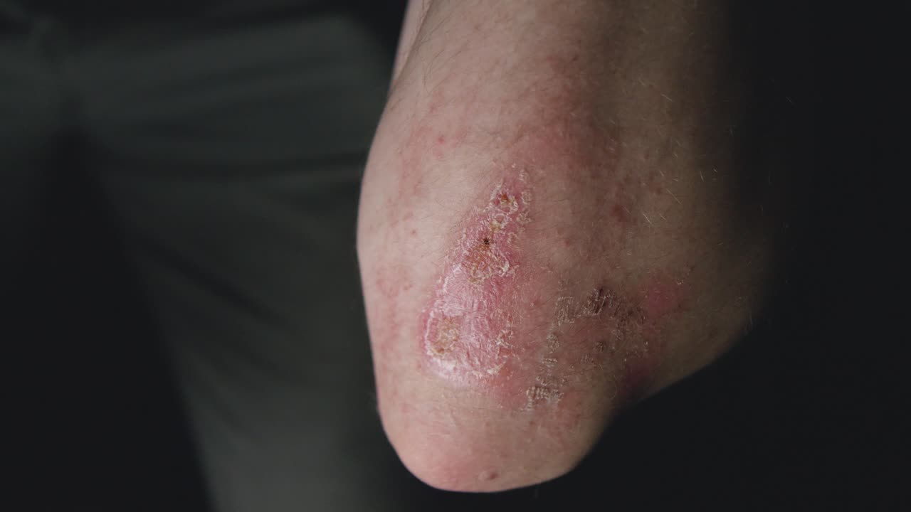 la costra curativa en el codo masculino