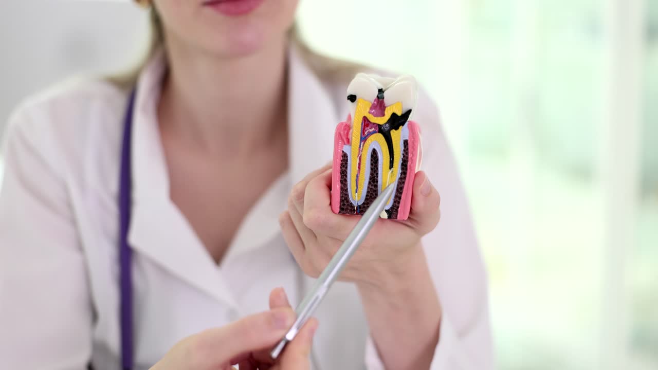 Mani di dentista con un dente con carie in clinica dentale