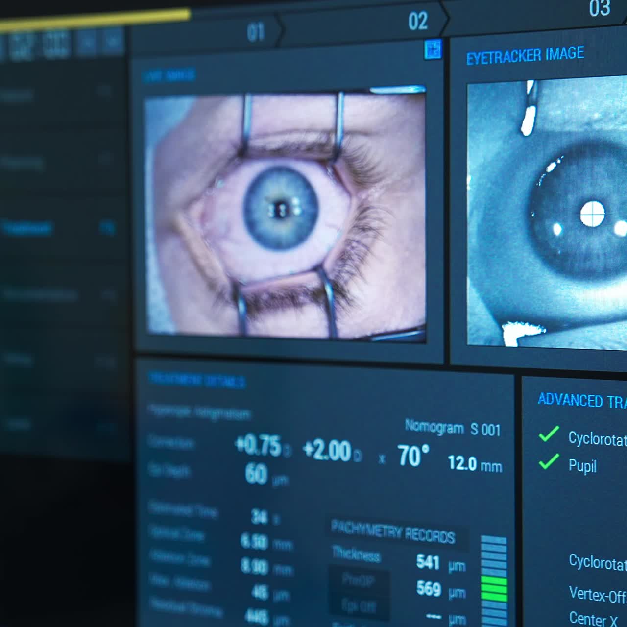 Computer monitoring eye laser corrective operation. eye screen monitor on operation