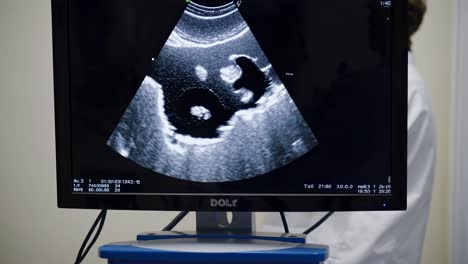 ultrasound images of a fetus