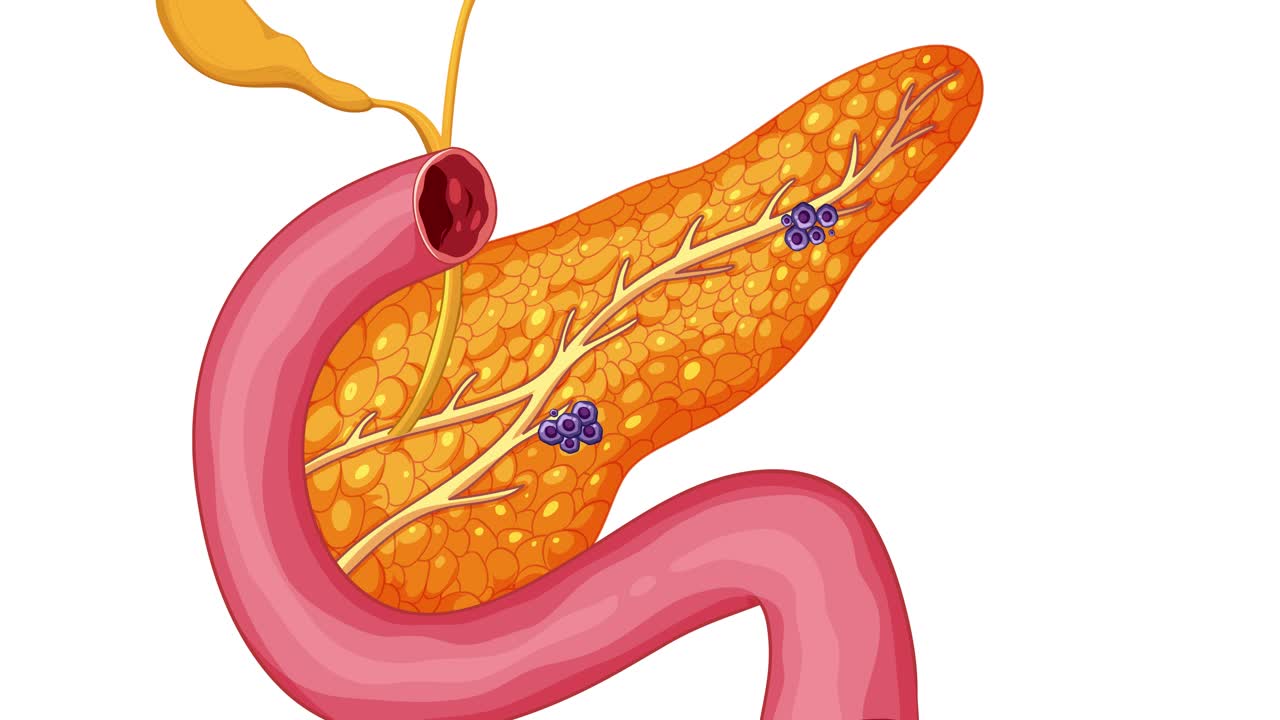Illustrates pancreatic cancer progression through lymph nodes to the liver using detailed medical animation