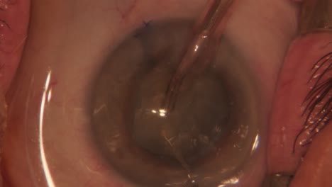 cleaning cataract in the eye. macro footage of eyes during eye surgery. ophthalmological surgery.