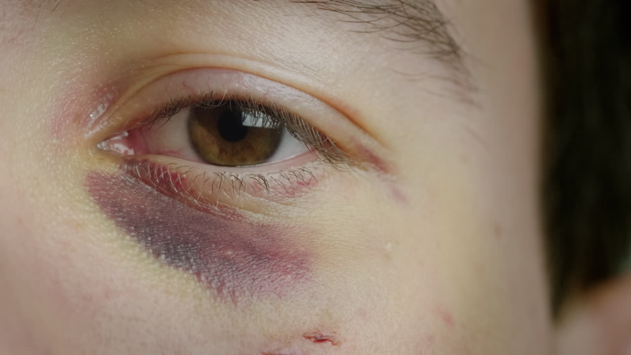 el ojo de un hombre con un hematoma y abrasiones
