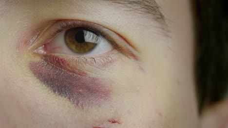 The-eye-of-a-man-with-a-bruise-and-abrasions