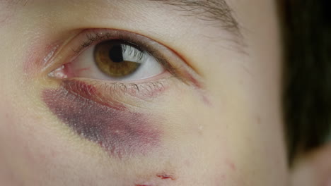 el ojo de un hombre con un hematoma y abrasiones