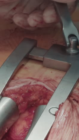 el médico realiza un bypass con un primer plano del dilatador. el cirujano expande meticulosamente la arteria coronaria preparándose para una cirugía de bypass crítica en la sala de operaciones del hospital
