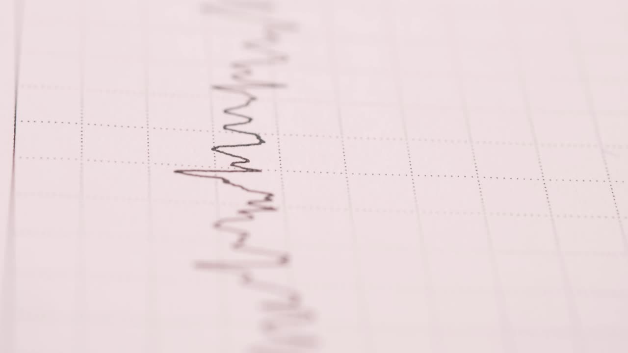 ECG/Electrocardiogram Graph