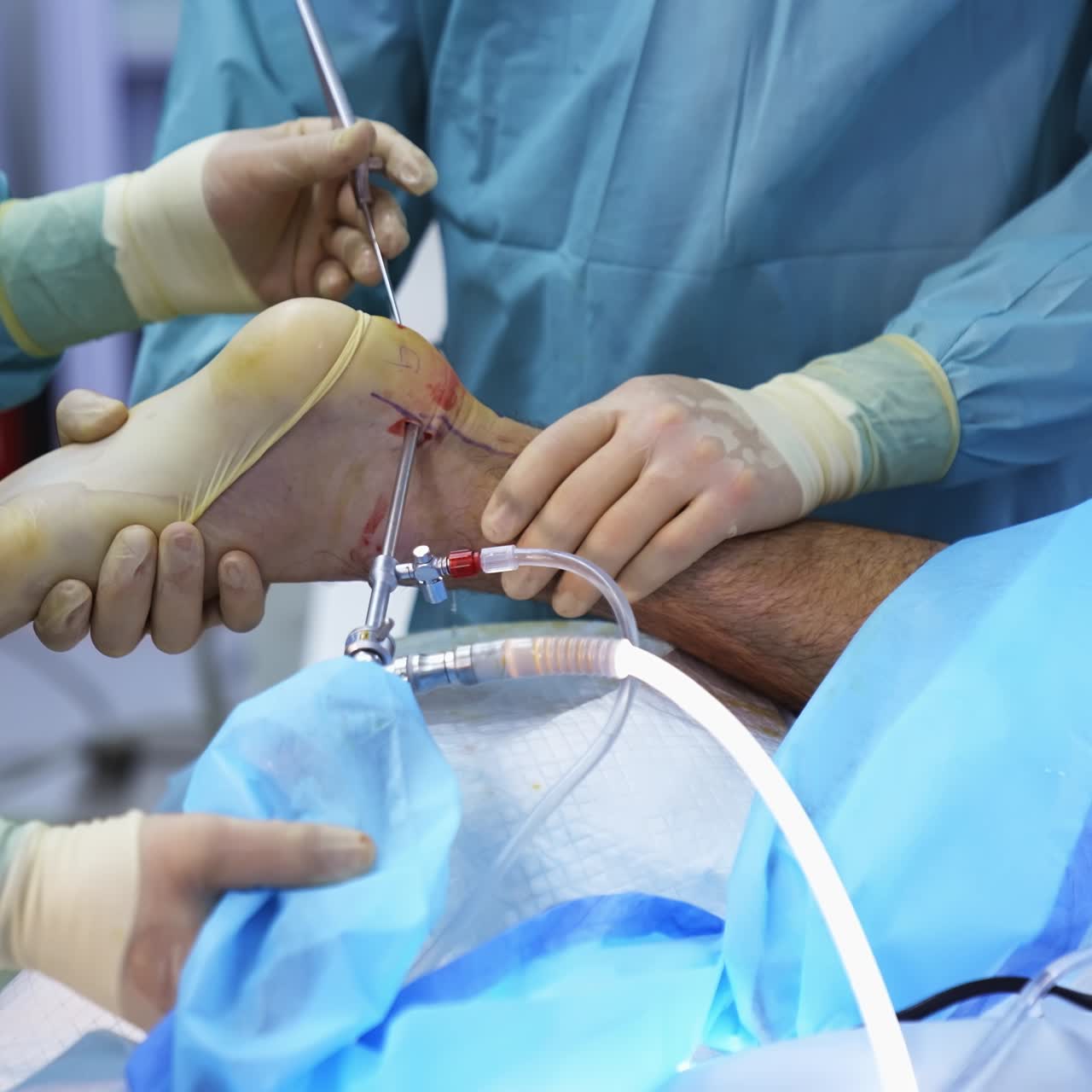 Group of surgeons in operating room with surgery equipment