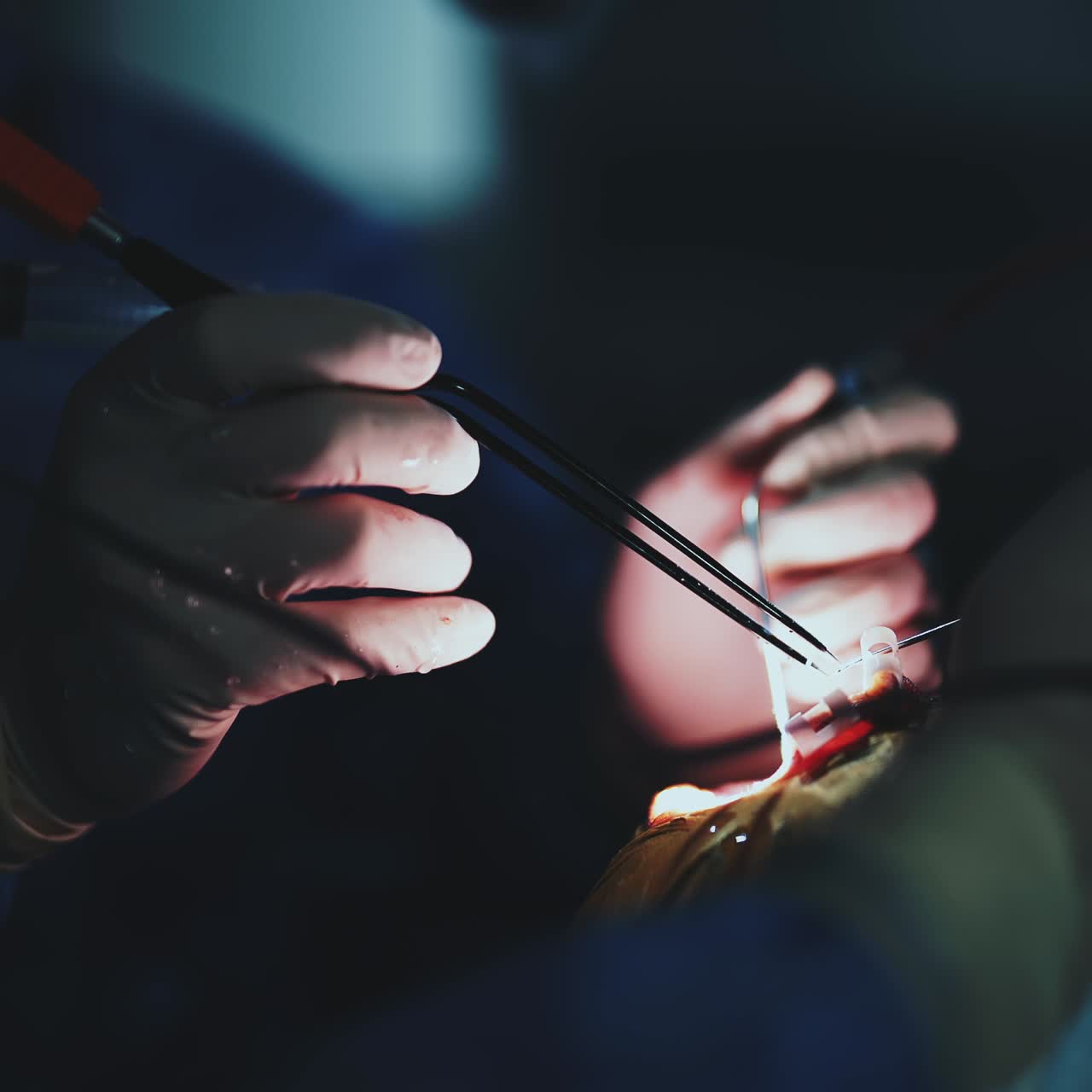 Careful gloved hands of a surgeon operating the patient with the help of tools. Surgery in neurology in the dark operational room. Close up
